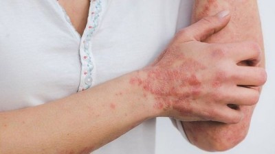 Inflamatory Skin Conditions CRH 2023.jpeg
